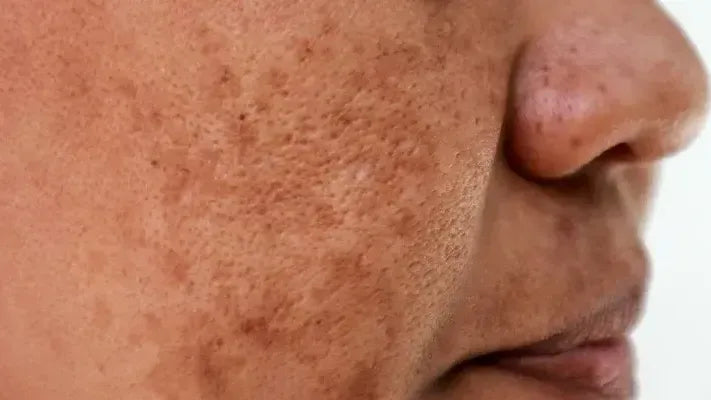 Understanding Melasma: Causes, Symptoms, and Treatment Options