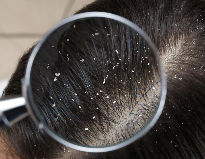 Dandruff: causes, remedies and tips that help