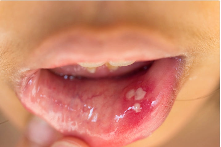 Causes of Mouth Ulcer and How to Treat Them?