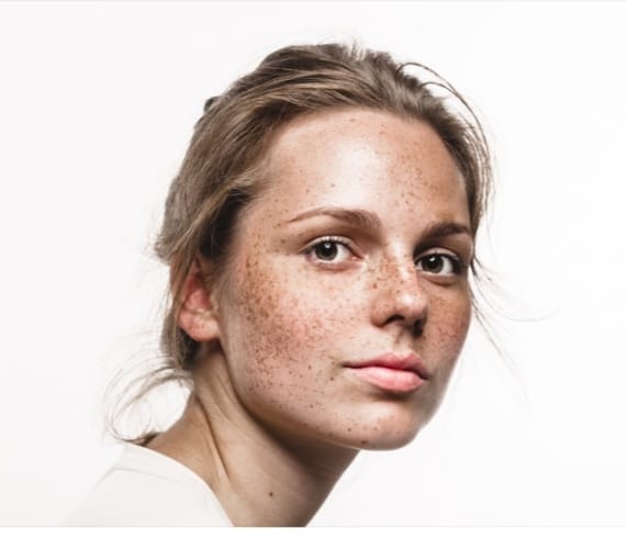 Hyper pigmentation: Here’s all you need to know