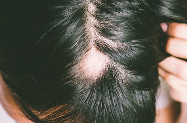 Alopecia Areata: 10 Remedies and Foods that help