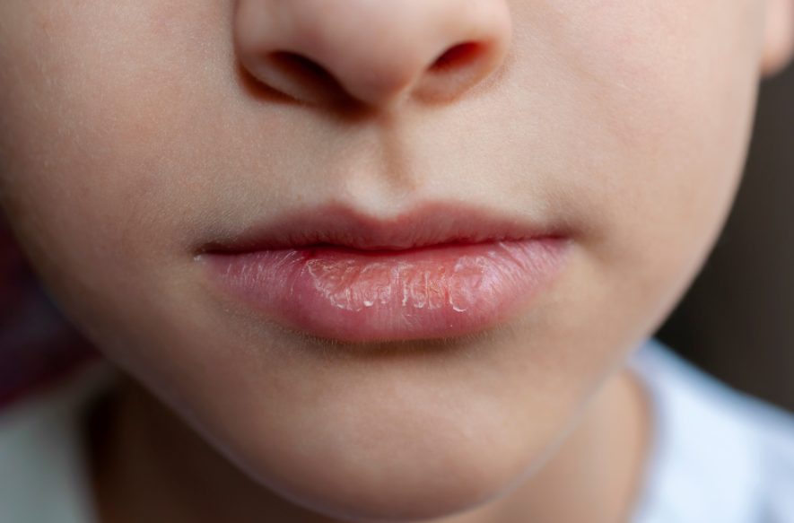 8 Effective Dry and Chapped Lips – Home Remedies