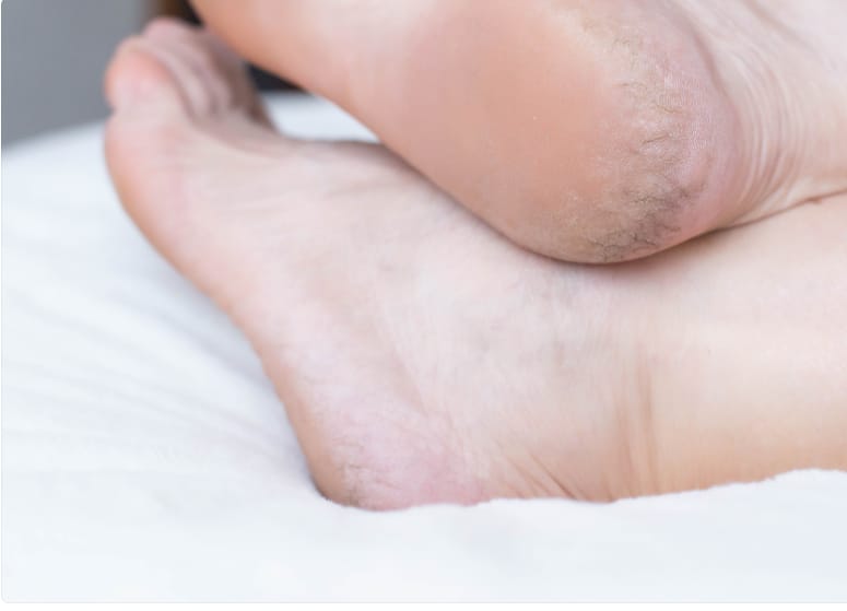 How to cure a cracked heel? Remedies at home!