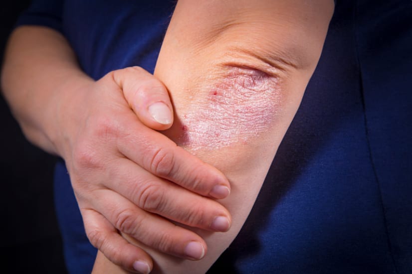 What triggers eczema? 8 Tips for treating eczema