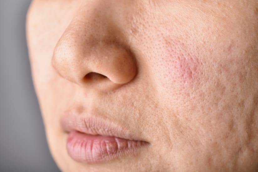 12 best open skin pores remedies at home